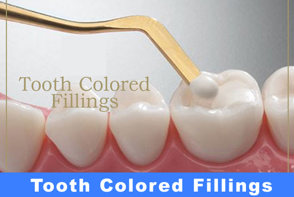 Tooth Colored Fillings